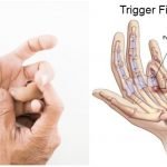 trigger finger